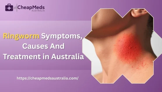 Ringworm: Symptoms, Causes And Treatment in Australia