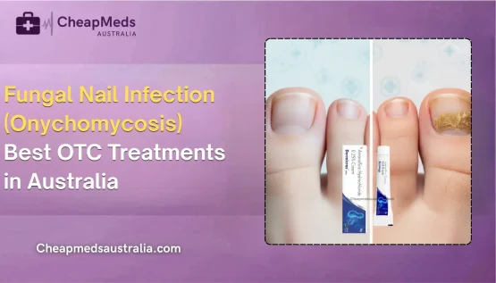 Fungal Nail Infection (Onychomycosis): Best OTC Treatments in Australia